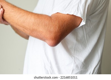 Man Swelling Erythematous Lump Pain Elbow From Olecranon Bursitis, Student Elbow Medical Condition. Inflammation Of The Bursa Located Under The Elbow Olecranon Trauma Or Repetitive Smaller Traumas. 