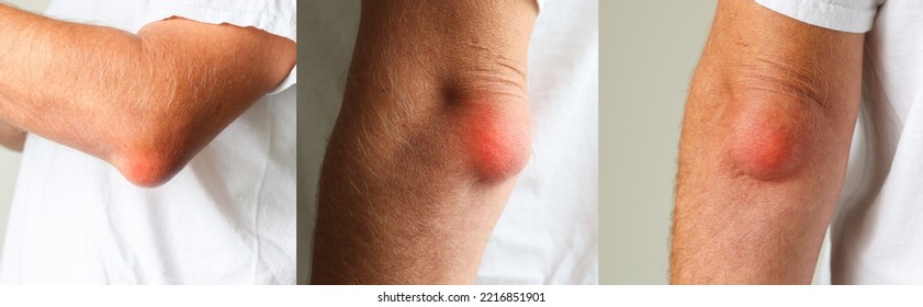 Man Swelling Erythematous Lump Pain Elbow From Olecranon Bursitis, Student Elbow Medical Condition. Inflammation Of The Bursa Located Under The Elbow Olecranon Trauma Or Repetitive Smaller Traumas. 