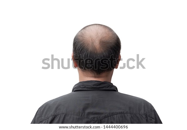 Man Thin Hair Men Have Hair Stock Photo Edit Now 1444400696
