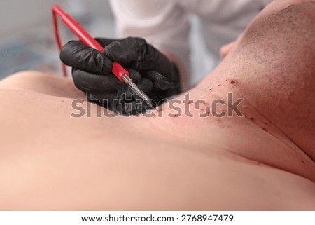 Man undergoing procedure to remove warts and papillomas. Laser removal of papillomas on skin. Laser cauterization of benign growths on skin. Prevention of melanoma. Aesthetic medicine.