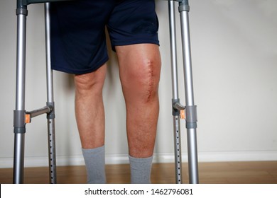 Man With Walker After Knee Replacement Surgery, Stitches Close Up. Painful Scar After Knee Surgery