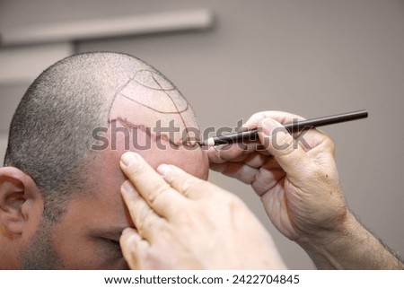 The man without hair is skin marked by the doctor at the hair transplant center for the place to be transplanted. sapphire techniques. Patient suffering from hair loss in consultation with a doctor. Stock photo © 