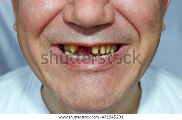 2本の歯を持たず 顔に傷を付けて橋渡しをするために上歯を剥いた人 の写真素材 今すぐ編集