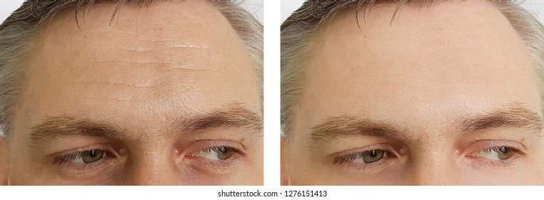 Man Wrinkles Before And After Procedures