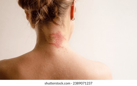 Manifestation of atopic dermatitis as a red itchy spot on a woman’s neck, close-up, rear view, copy space. Dermatology, allergy, itching, red spot or rash on skin - Powered by Shutterstock