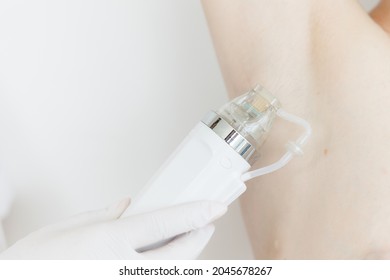 A Maniple, A Nozzle For A Cosmological Procedure. Needle Rf-lifting. The Girl's Armpit. Cosmetology And Medical Services Office. Microneedle Radio Frequency Lifting Device. Hardware Cosmetology.