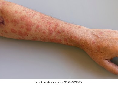 Man's Arm With Herpes Virus Skin Patches