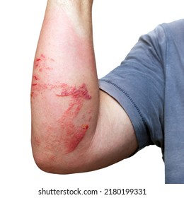 A Man's Arm With Skin Burns, Swelling And Injuries Caused By The Touch Of A Jellyfish While Swimming In The Sea Isolated On The White Background