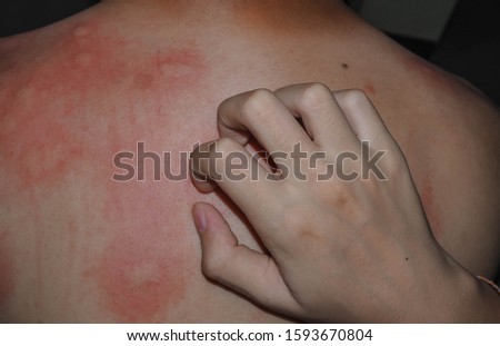 A man's back bite of a mosquito on the background