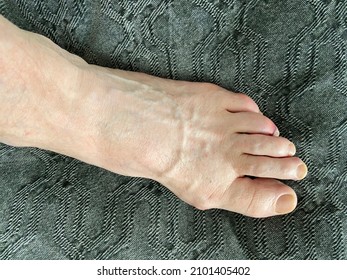 Man's Bare Foot With Stubbed Toe Hematoma