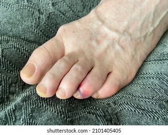 Man's Bare Foot With Stubbed Toe Hematoma