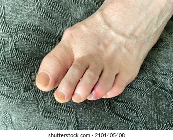 Man's Bare Foot With Stubbed Toe Hematoma