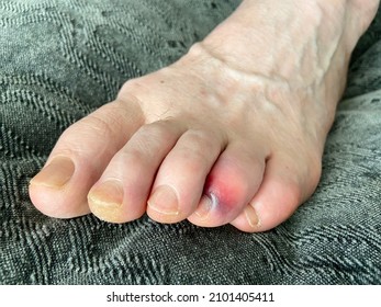 Man's Bare Foot With Stubbed Toe Hematoma