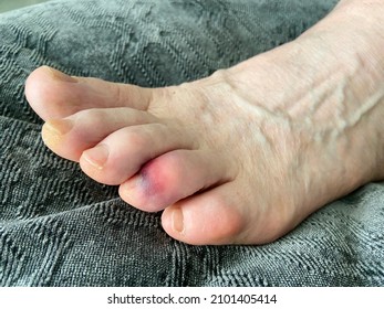 Man's Bare Foot With Stubbed Toe Hematoma