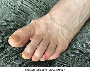 Man's Bare Foot With Stubbed Toe Hematoma