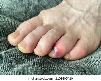 Man's Bare Foot With Stubbed Toe Hematoma