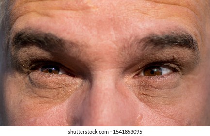 Man's Eyes With Dark Circles.  Bags Under  Eyes. Medical Eye Conditions, Skin Aging- Concept.