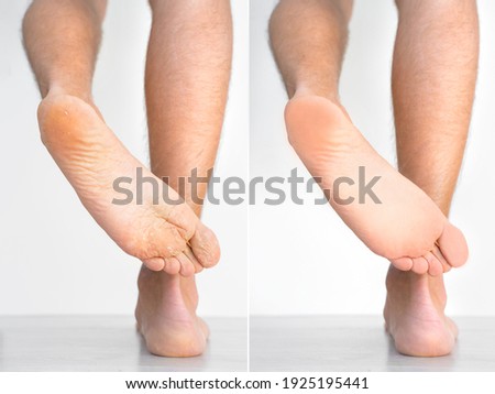 Man's feet with dry skin before and after treatment. Fungal infection or athlete's foot, dry skin, dermatitis, eczema, psoriasis or sweaty feet. Health care concept