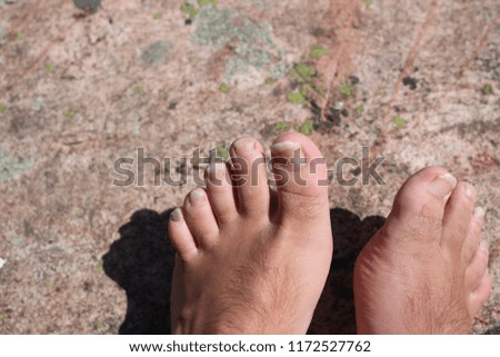 Mans gross feet isolated on a rock background. concept of healthcare and foot care 