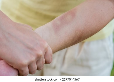 Man's Hand Keep Woman's Hand With Bruise. Violence Against Women. Battering A Woman And Domestic Violence