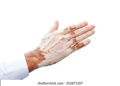 Man's Hand With With Vitiligo On White Background.