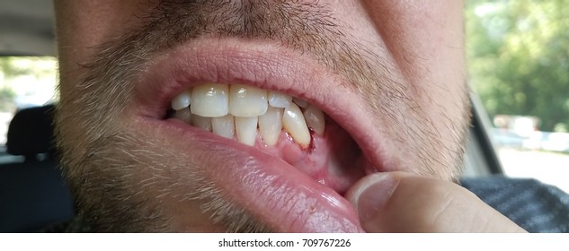 Man's Nasty Bloody Gums And Tooth