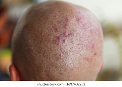 Scalp acne natural treatment