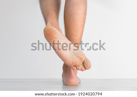 Mans showing his dry feet. Peeling and cracked foot. Fungal infection or athlete's foot, dry skin, dermatitis, eczema, psoriasis, sweaty feet or dehydration. Health care concept