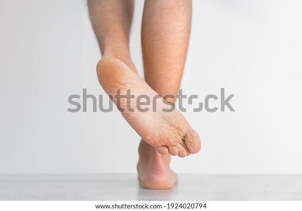 Mans showing his\
dry feet. Peeling and cracked foot. Fungal infection or athlete\'s\
foot, dry skin, dermatitis, eczema, psoriasis, sweaty feet or\
dehydration. Health care\
concept