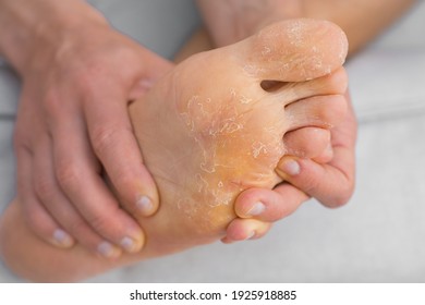 Man's showing his peeling and cracked feet. Fungal infection, eczema, psoriasis, sweaty feet. Health care concept.