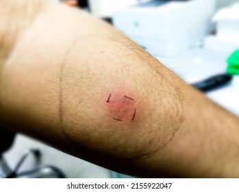 Mantoux Vaccination, Closeup View Photography Of Patient Arm With Red Spot Reaction To Conducting Mantoux Test. Positive Tuberculosis Patient.