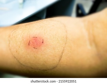 Mantoux Vaccination, Closeup View Photography Of Patient Arm With Red Spot Reaction To Conducting Mantoux Test. Positive Tuberculosis Patient.