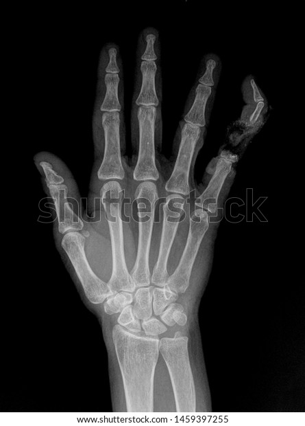 Manus X Ray Anatomy Radiology Radiographic Stock Photo 1459397255 ...