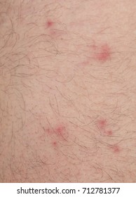 Many Flea Bites Over Caucasian Man Skin