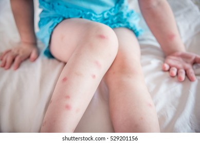Many of mosquito bites sore and scar on little child legs who sitting on bed 
