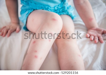 Many of mosquito bites sore and scar on little child legs who sitting on bed 