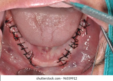 Dental Stitch High Res Stock Images Shutterstock