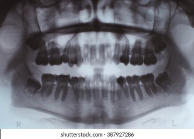 many teeth x ray
