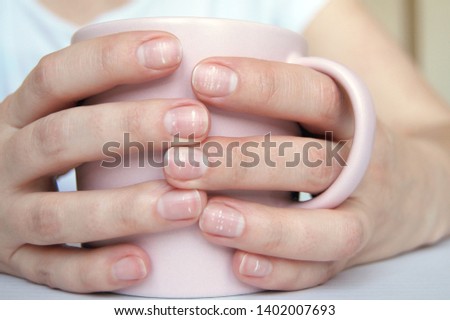 Many white spots on fingernails (Leukonychia) due to calcium deficit or stress. Female hands holding mug