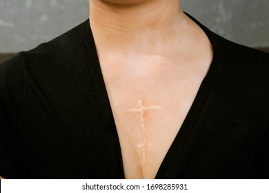 A Mark On The Skin After A Child's Heart Surgery. Heart Disease. Scar On The Body.