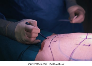 marking cutting lines for tummy tuck