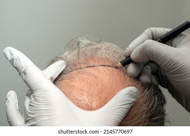 Marking hair line Point of receding hair line for hair transplant surgery.  - Shutterstock ID 2145770697