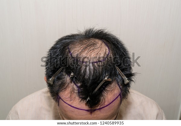 Marking Hair Line Point Receding Hair Stock Image Download Now