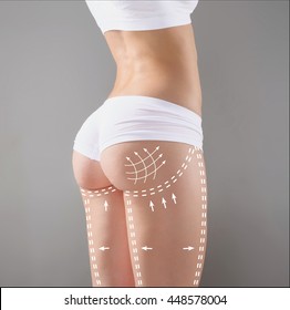 Marks on the women's buttocks, waist and legs before plastic surgery. - Shutterstock ID 448578004