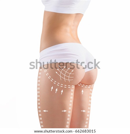 Marks on the women's buttocks, waist and legs before plastic surgery.