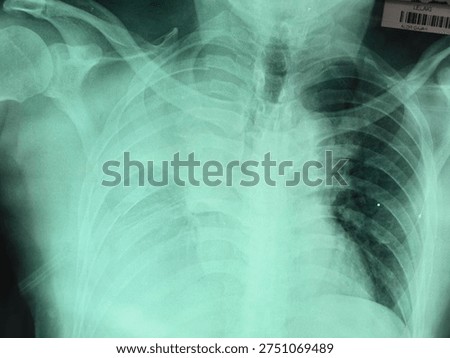 Massive Right Lung Haemothorax with multiple fractured ribs.