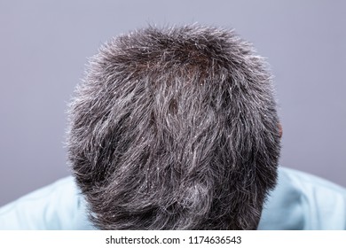 Mature Man With Dandruff Scratching His Head