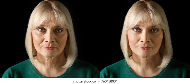 Mature Woman Before And After Biorevitalization Procedure On Black Background