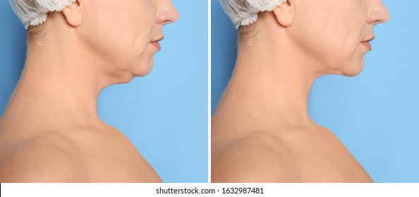 Mature woman before and after plastic surgery operation on blue background, closeup. Double chin problem