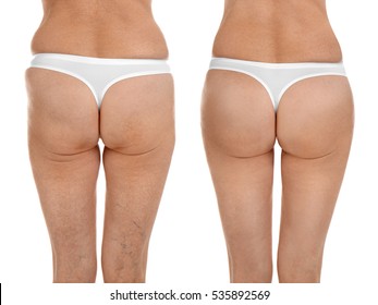 Mature woman body before and after liposuction. Plastic surgery concept.